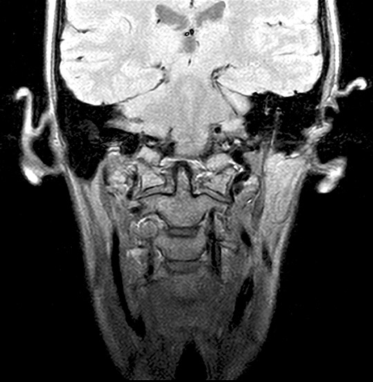 MRI Cranio-Cervical Junction Scan (AI Enhanced)